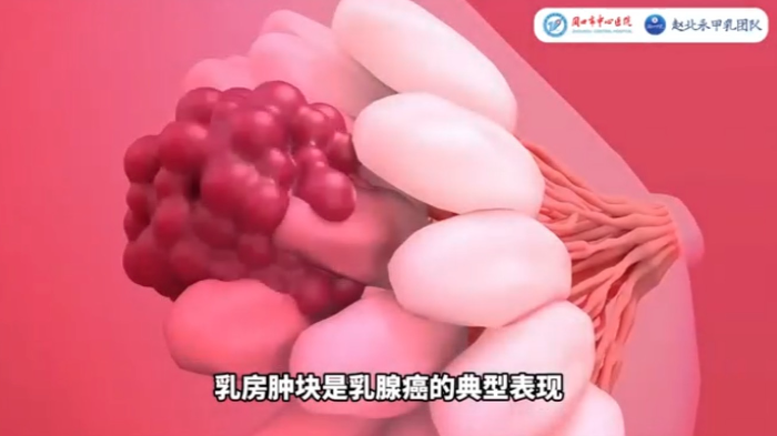 <span style="color: #da4707">乳腺</span>肿瘤专家带你认识<span style="color: #da4707">乳腺</span>癌