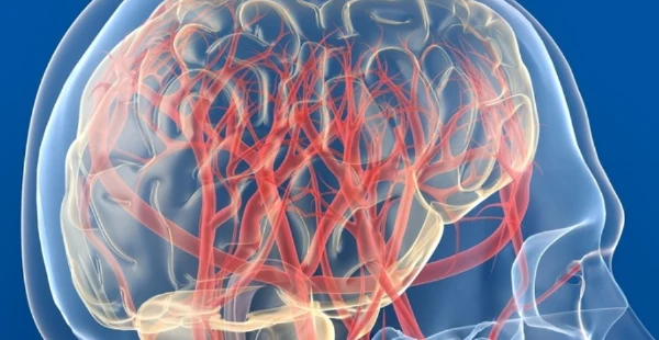 全面认识及应对大脑血管动静脉畸形——从诊断到治疗