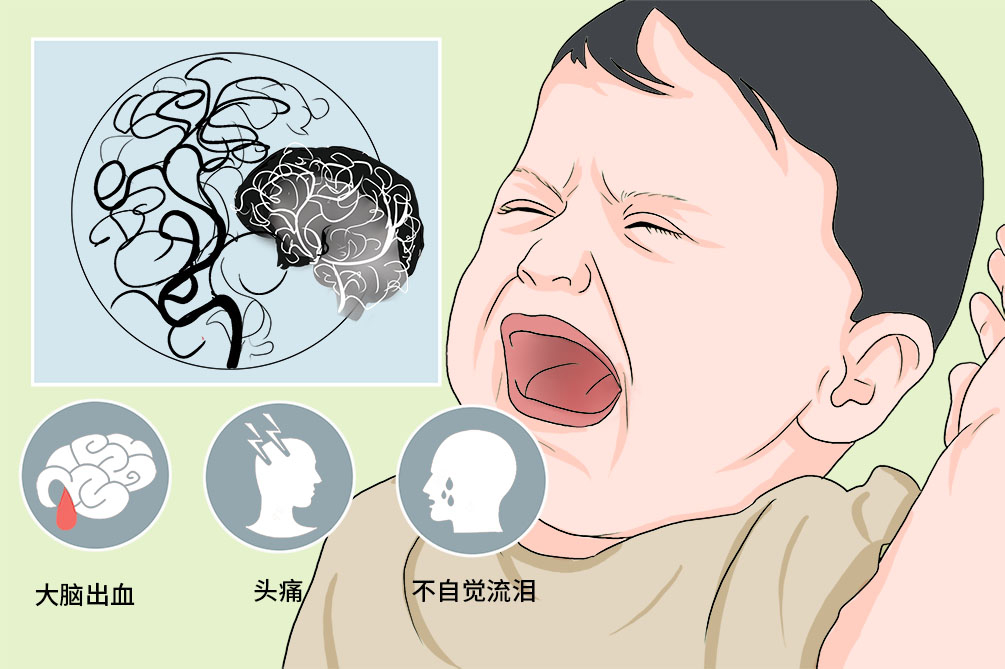 全面了解出血型烟雾病——从诊断到治疗