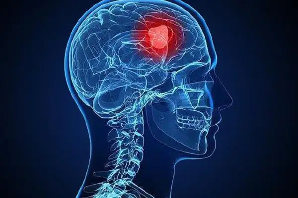 恶性脑肿瘤：全面解析及生活管理