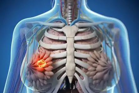 乳腺癌患者围手术期麻醉管理:如何平衡镇痛与安全性?
