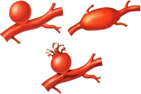 动脉瘤：识别、诊断与治疗全指南