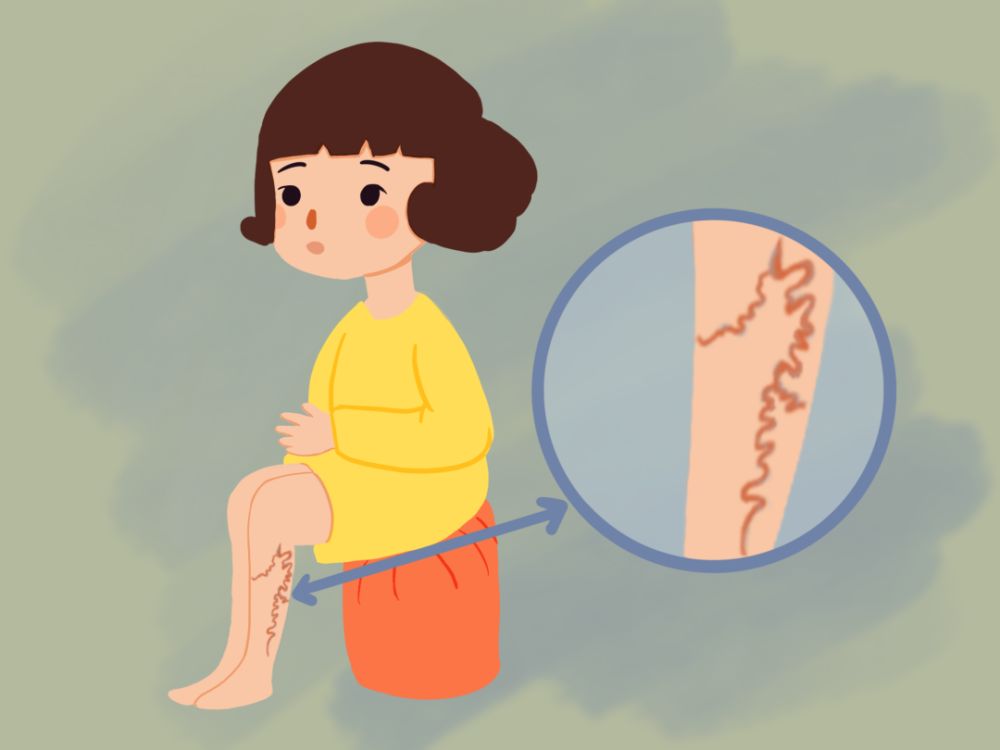 了解大隐静脉曲张及其治疗方法封面图