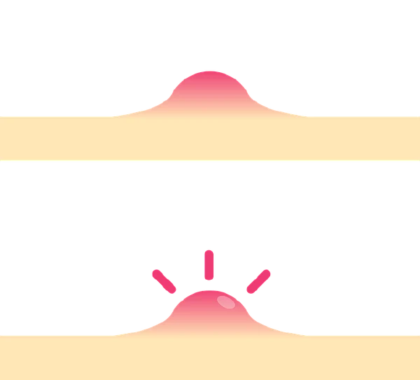 青春期皮肤大作战！— 痤疮和皮肤划痕性荨麻疹的真相与防治