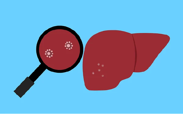 深入了解慢性乙型肝炎：诊断、分期及治疗