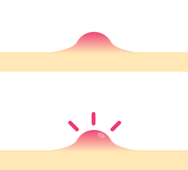 夏季皮炎与<span style="color: #da4707">痤疮</span>：了解与应对！