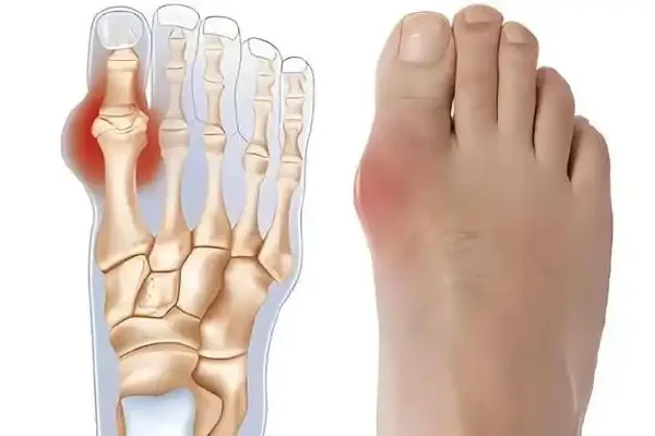 如何有效预防和治疗痛风性关节炎