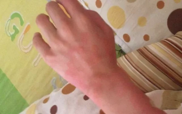 过敏性皮炎：症状、诊断与治疗全解析