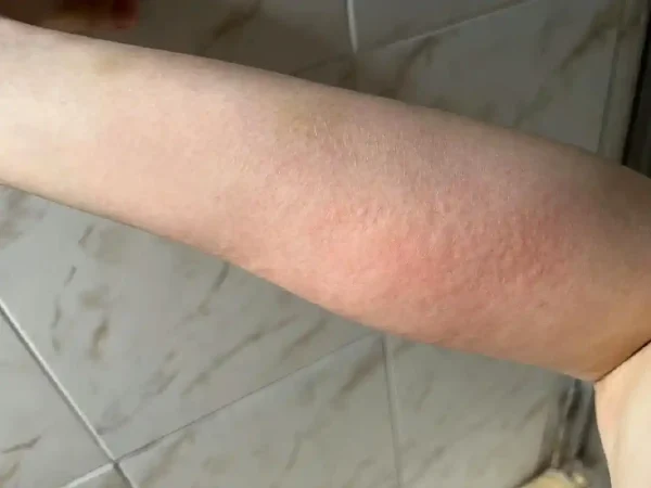 抗战荨麻疹，重新找回舒适生活