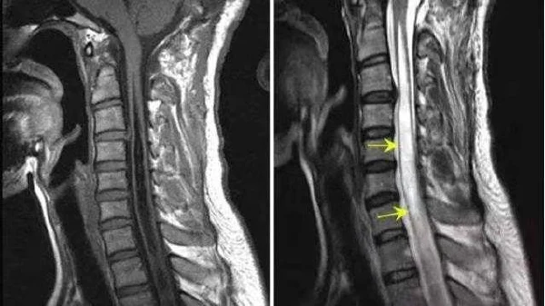解密脊髓空洞症：探究脊髓中“黑洞”的潜在威胁