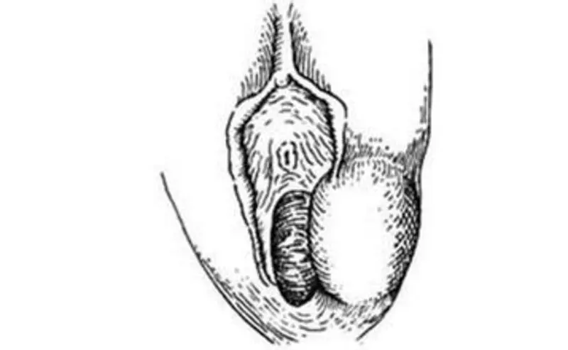 前庭大腺囊肿—你可能不知道的<span style="color: #da4707">妇科</span>常见<span style="color: #da4707">问题</span>！