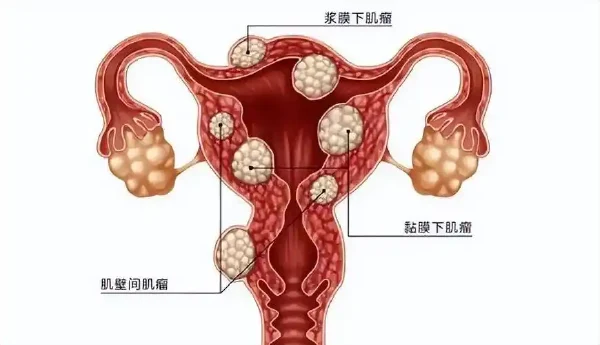 看不见的敌人——子宫平滑肌瘤与女性健康