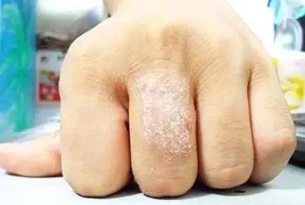 湿疹的分类、诊断、分期与治疗：全面指南