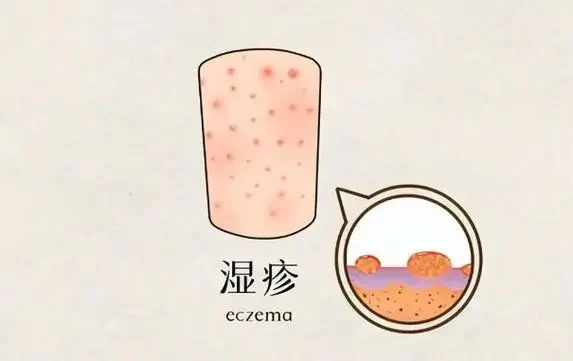 湿疹护理全攻略——药物的选择与使用,深度解析!