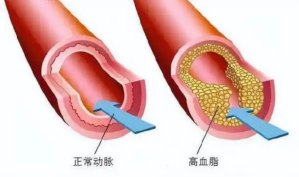 全面解析<span style="color: #da4707">高脂血症</span>：分类、诊断、分期与治疗