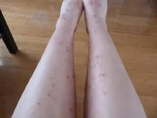 湿疹：那些你不得不知的皮肤“小插曲”