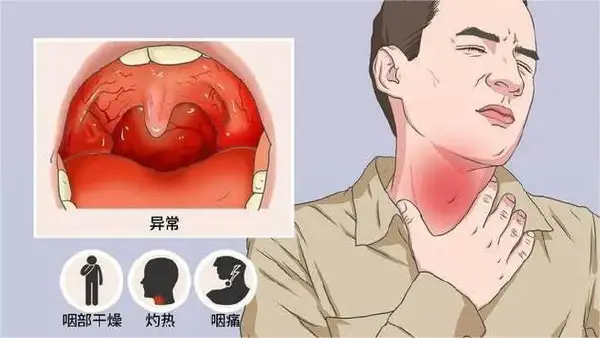 咽喉健康警示 – 为什么你的咽炎需要重视?