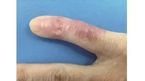 皮肤感染及炎症:老年人不容忽视的皮肤健康问题