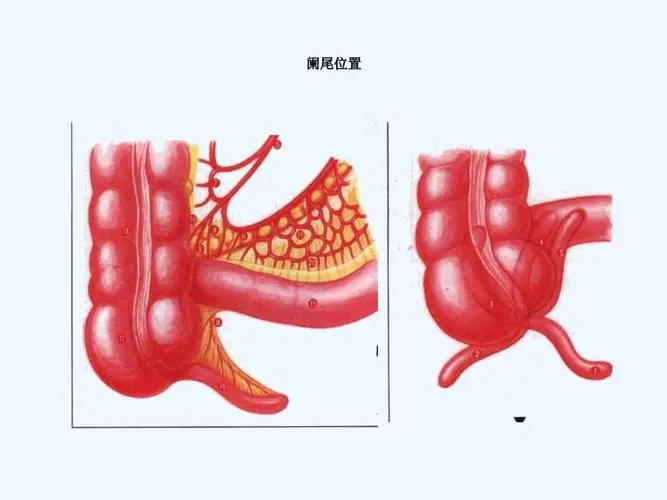 急性阑尾炎：让你躲不过的“肚子怪痛”！