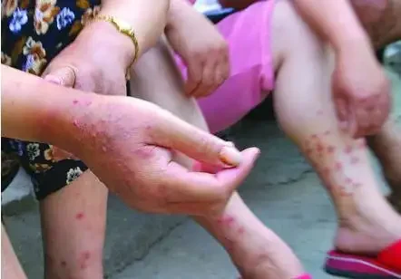 远离过敏性皮炎——保护皮肤从现在开始!