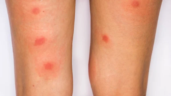 慢性荨麻疹:怎么破?专业讲解+预防攻略