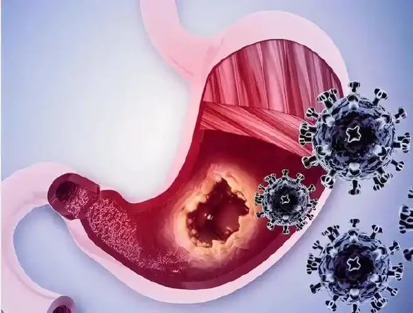 健康在手，谨防胃癌：识别与预防指南