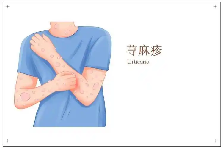 快速<span style="color: #da4707">缓解</span>宝宝的急性荨麻疹！科学治疗与预防<span style="color: #da4707">方法</span>详解