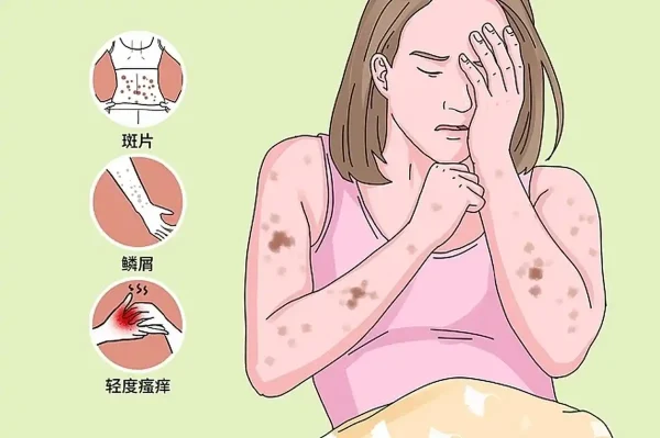 慢性荨麻疹:了解、治疗与预防