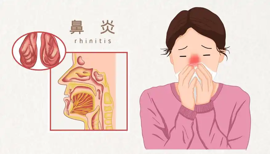 战胜鼻炎——揭开您不知道的真相！封面图