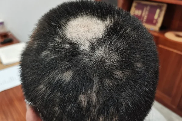 关注健康,从日常做起:深度了解斑秃、湿疹及脂溢性皮炎