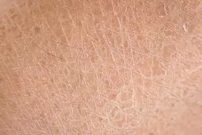 面对皮肤感染和湿疹,不再烦恼!你的健康指南