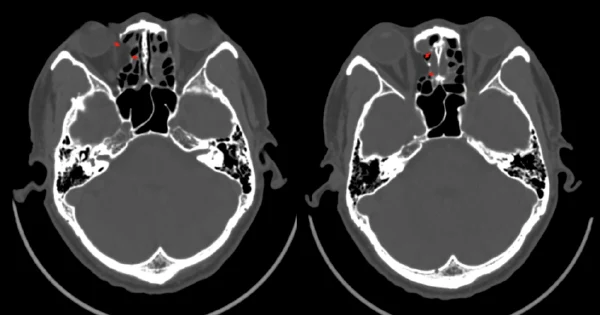 天有不测风云：左眼眶骨折，你了解它的危害与治疗吗？！