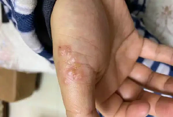 皮炎引发的皮疹:如何辨别、治疗和预防