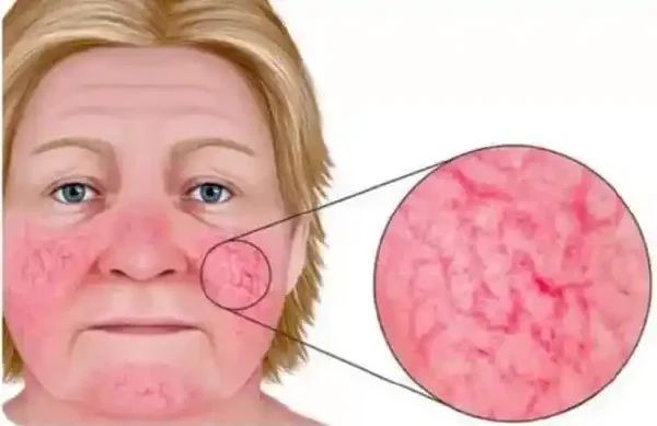 如何应对玫瑰痤疮和面部皮炎？必读指南！