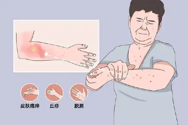 荨麻疹:你需要知道的一切