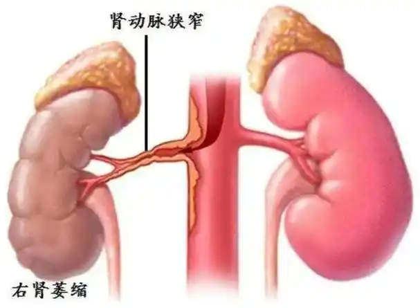 肠系膜上动脉闭塞与肾动脉狭窄：老年健康的无声威胁