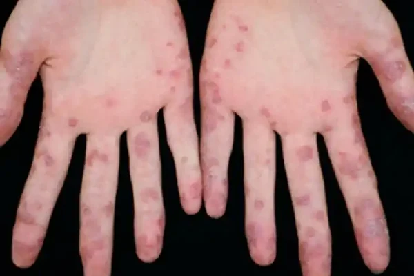 红斑狼疮、甲亢、荨麻疹:多重疾病来袭,如何应对?