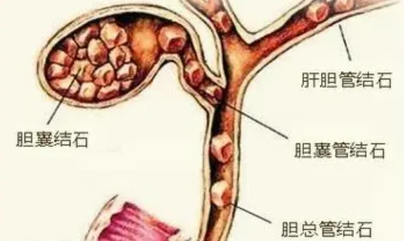 全面解析胆总管结石:从诊断到治疗的全方位指南