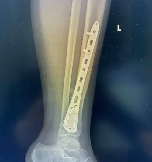胫骨骨折:从诊断到康复,你需要了解的所有信息