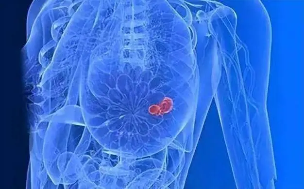 全面解析乳腺癌的类型与治疗：专注luminalb型封面图