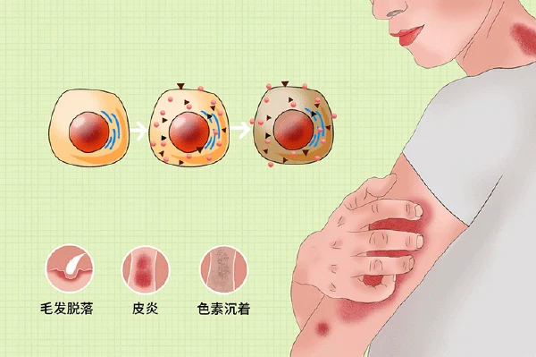 面对湿疹样皮炎:从理解到预防