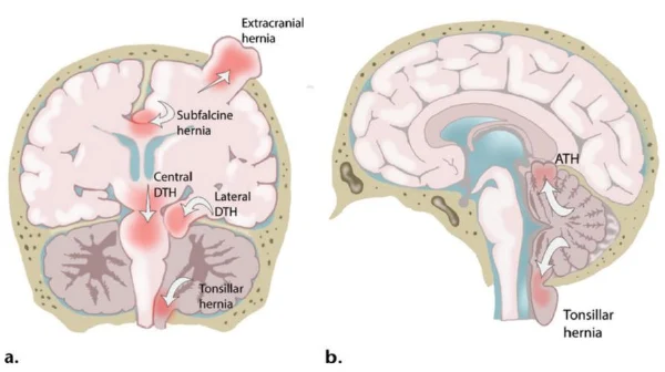 脑疝和基底节出血的临床特点与管理策略