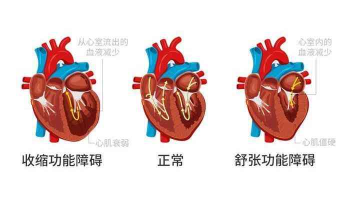 解开心衰之谜：如何预防心力衰竭