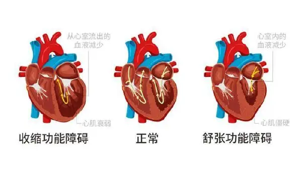 解开心衰之谜：如何预防心力衰竭