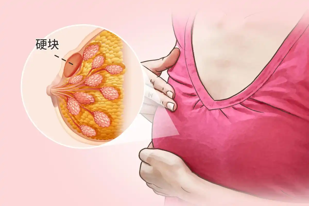 全面了解乳房<span style="color: #da4707">肿块</span>：从诊断到治疗