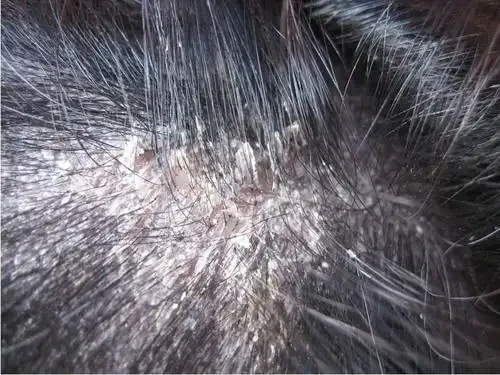 抛开烦恼，远离皮肤病：脂溢性皮炎与荨麻疹