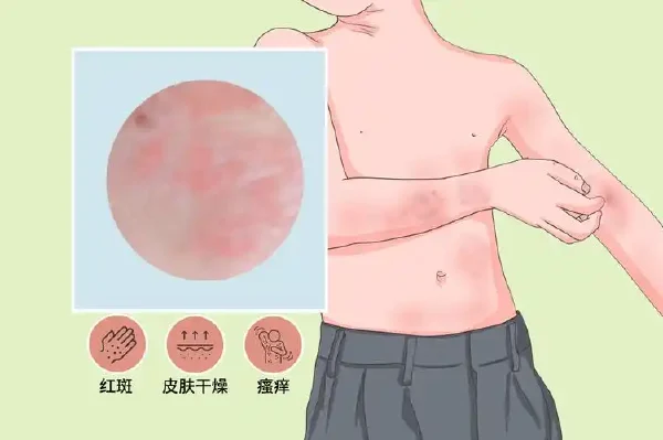 小小皮肤问题隐藏大秘密！—— 过敏性皮炎全科普