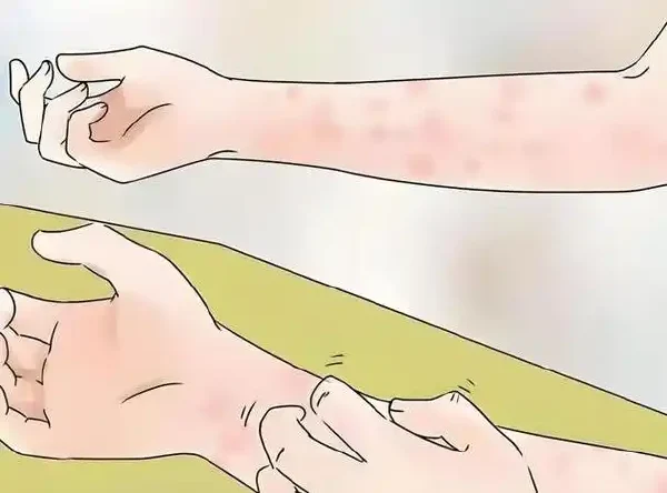 如何有效应对泛发性神经性皮炎?