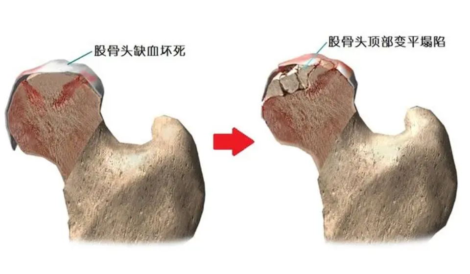 股骨头坏死不可忽视 - 如何有效预防与治疗！