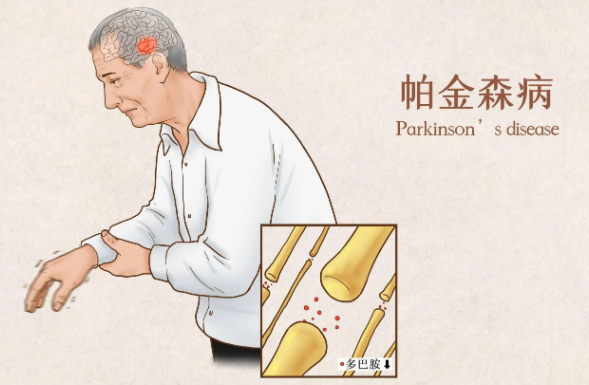 全面了解帕金森综合症：诊断、分期及治疗管理